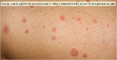 Мазь Афлодерм не назначают при сифилитическом поражении кожи