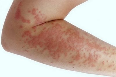 Жжение и высыпания - аллергическая реакция на мазь