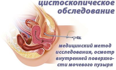 цистоскопическое обследование