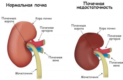 почечная недостаточность