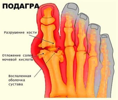 подагра