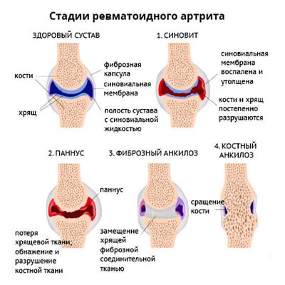 стадии ревматоидного артрита