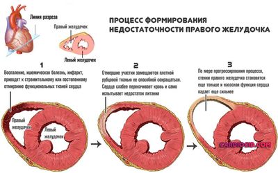 недостаточность правого желудочка