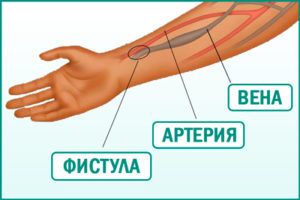 Формирование артериовенозной фистулы у пациентов с хронической болезнью почек