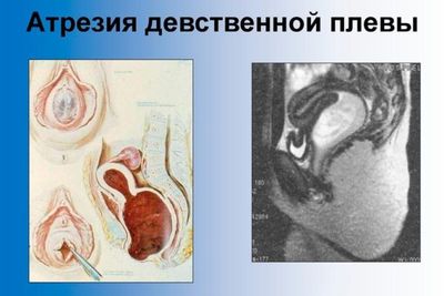Заращение (атрезия) девственной плевы: причины, симптомы, лечение