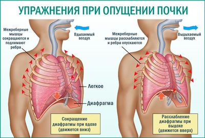 Упражнения при опущении почки для поднятия и лечения