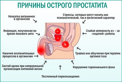 Острый простатит: причины