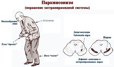 Причины возникновения, симптомы, стадии, как лечить болезнь Паркинсона?