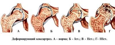 Стадии коксартроза сустава
