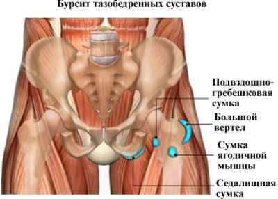 Бурсит сустава