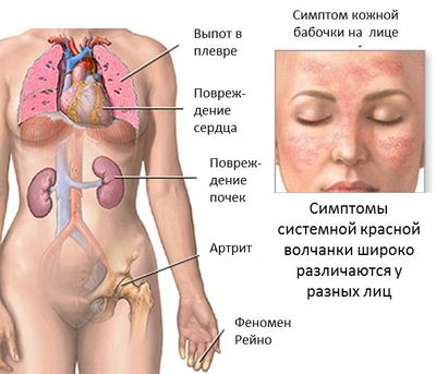 Признаки системной красной волчанки