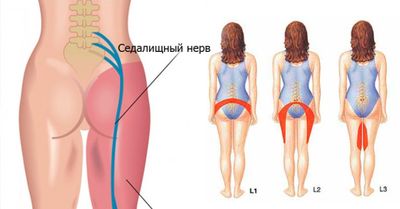 Признаки защемления