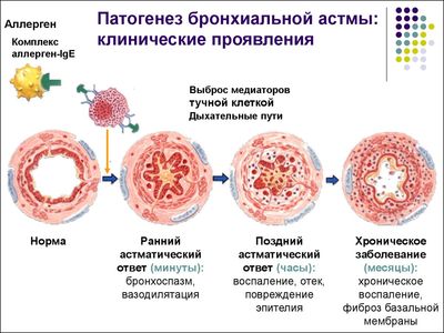 Проявления астмы