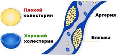 Как сделать чистку сосудов головного мозга