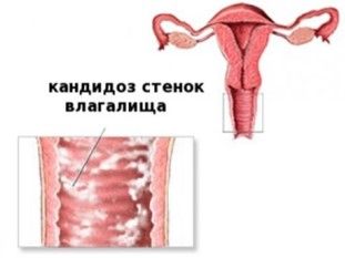 Генитальный кандидоз