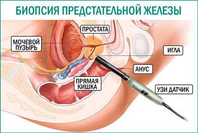 Биопсия простаты