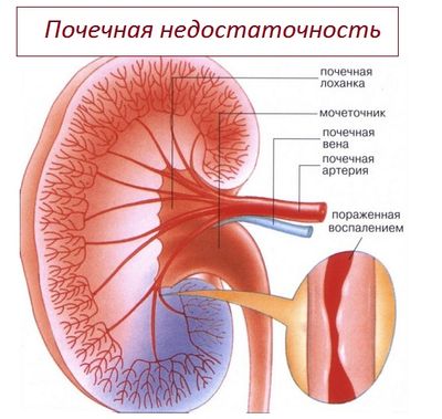 почечная недостаточность