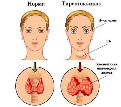 тиреотоксикоз