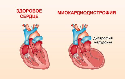 миокардиодистрофия