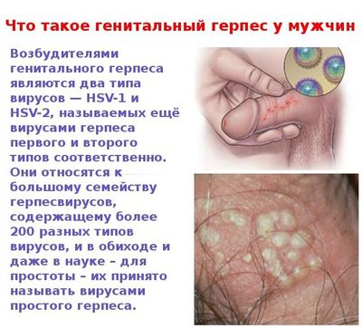 Что такое герпес на члене