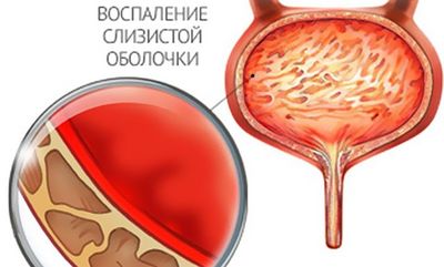 воспаление слизистой оболочки