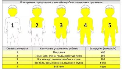 Гипербилирубинемия у новорожденных