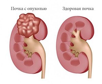 опухоль почки