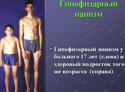 гипофизарный нанизм-1