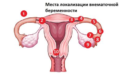 внематочная беременность места локализации