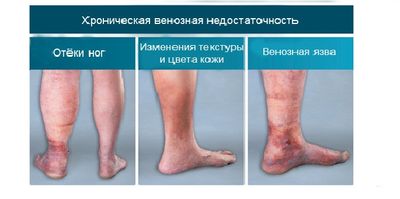 Мазь Индовазин показана при хронической венозной недостаточности нижних конечностей