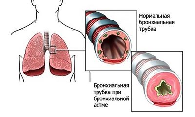 бронхоспази при бронхиальной астме