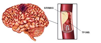 Бляшка