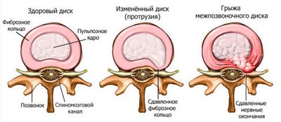 Показание к применению - грыжа позвоночника