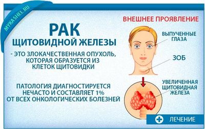 Рак щитовидной железы