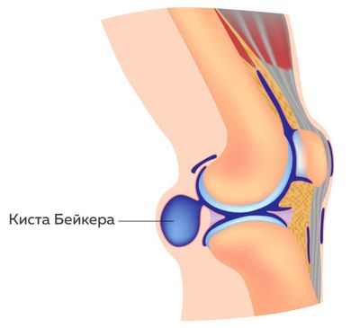 Расположение кисты Бейкера