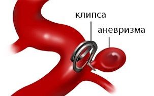 Клипирование аневризмы сосудов головного мозга и эндоваскулярная эмболизация