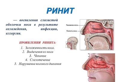 ринит