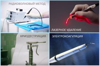 Радикальные ) методы лечения ВПЧ