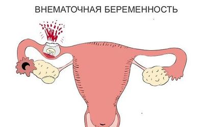 Внематочная беременность