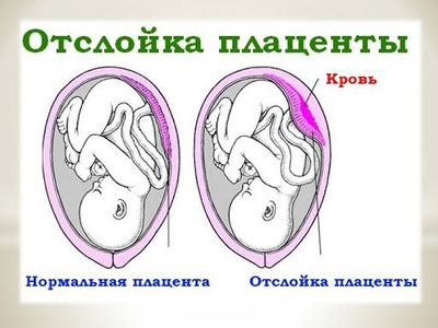 Плацентарное отслоение
