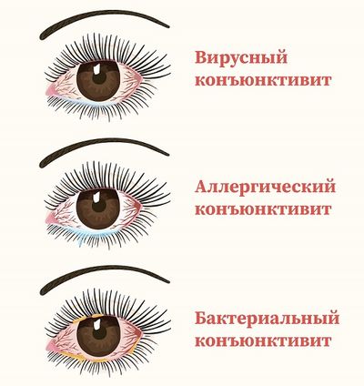 коньюктивиты