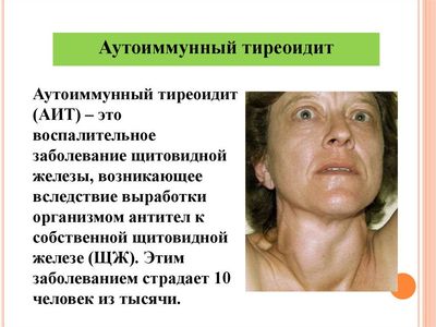 аутоиммунный тиреоидит-2