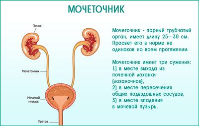 Особенности лечения камней в мочеточнике