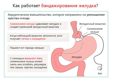 Как работает бандажирование желудка
