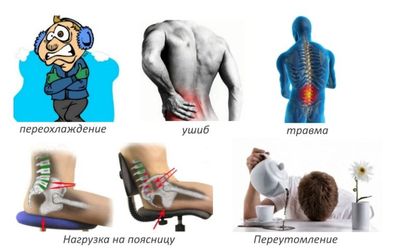 Причины люмбаго