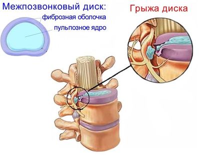 Обострение люмбаго