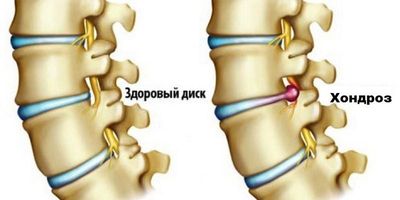Мазь используют в терапии хондрозов