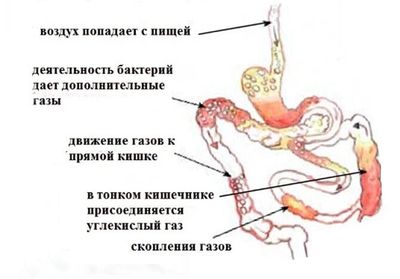 Симптомы и лечение метеоризма у взрослых