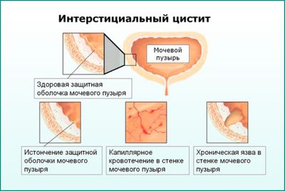Как выглядит цистит