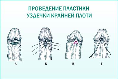 Пластическая операция на пенисе